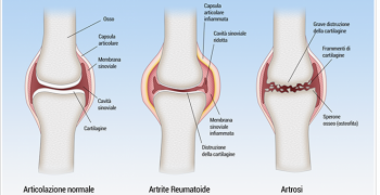 osteoartrite-cura