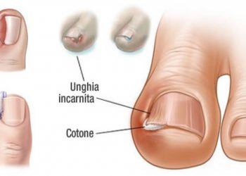 unghia-incarnita-rimedi