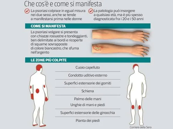 psoriasi rimedi