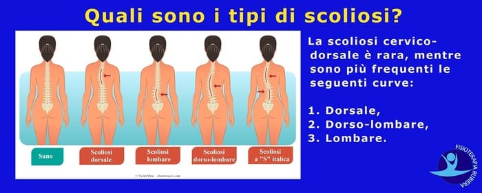 scoliosi tipi